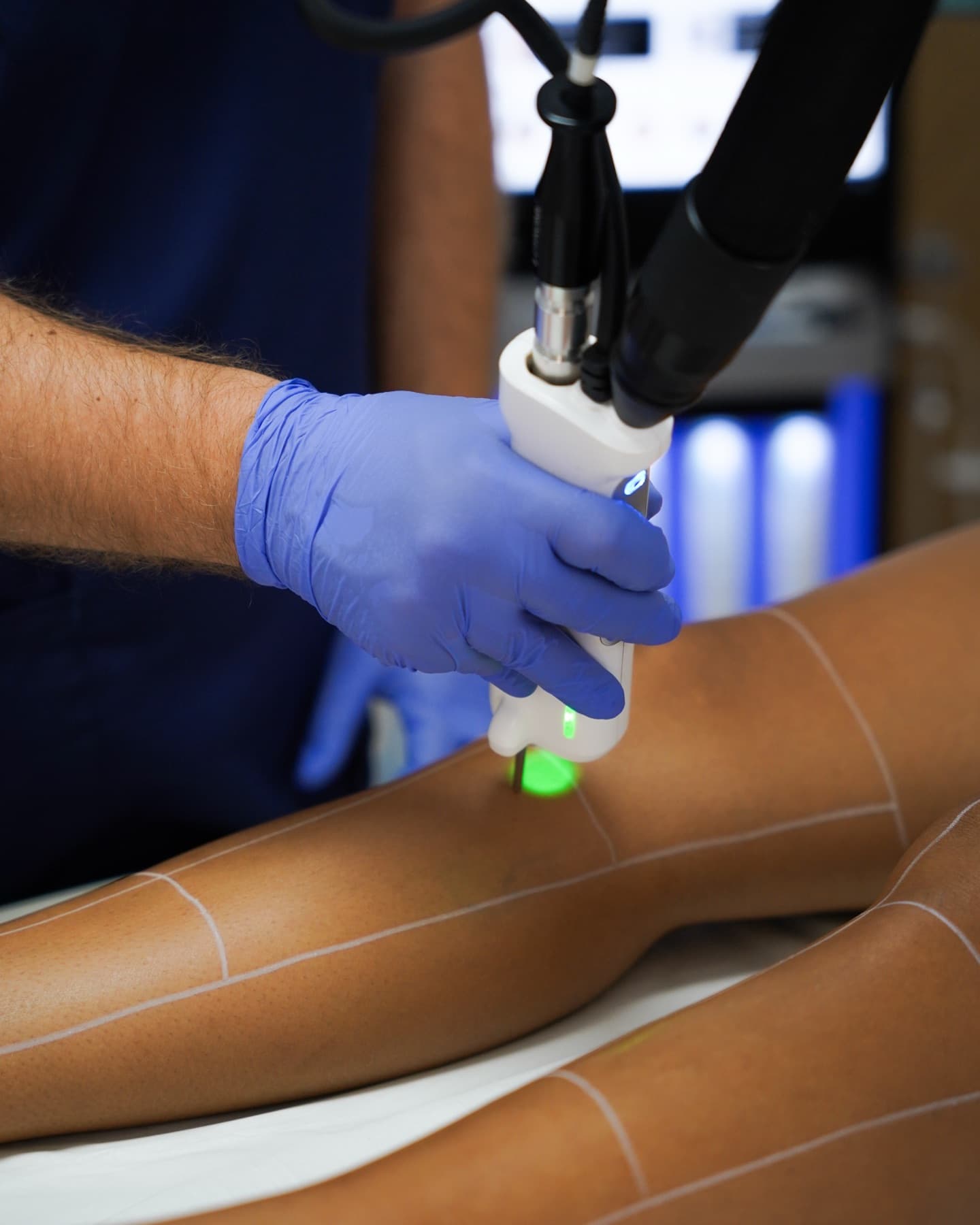 Traitement des jambes au laser